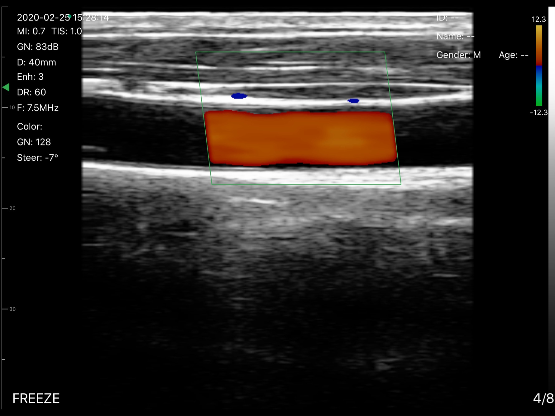 Carotid artery · Color Doppler · D3Pro · 7.5 MHz scan preview