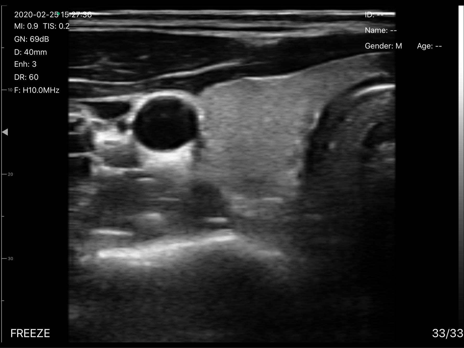 Thyroid lobe and common carotid artery · B-mode · D3Pro · 10 MHz scan preview