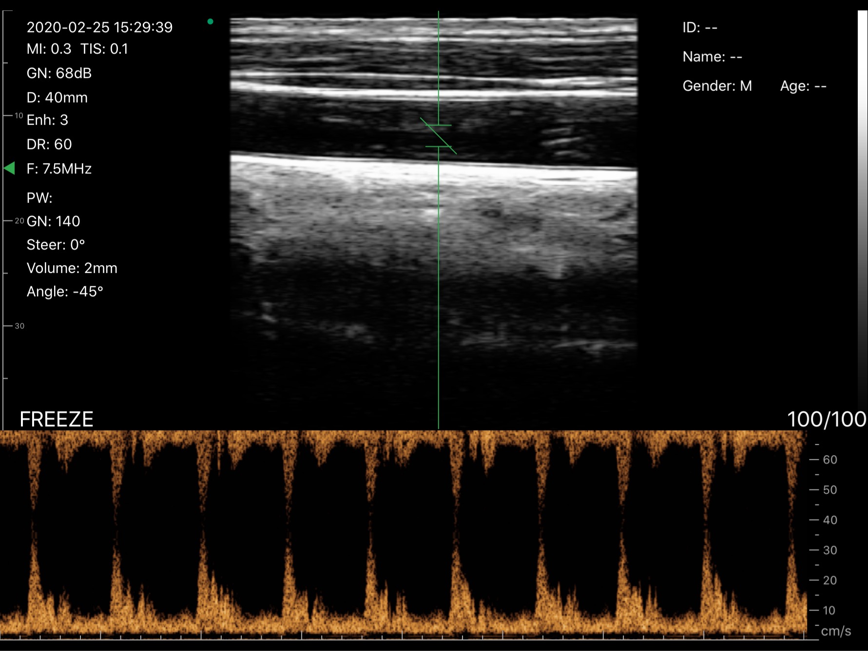 Carotid artery · PW Doppler · D3Pro · 7.5 MHz scan preview