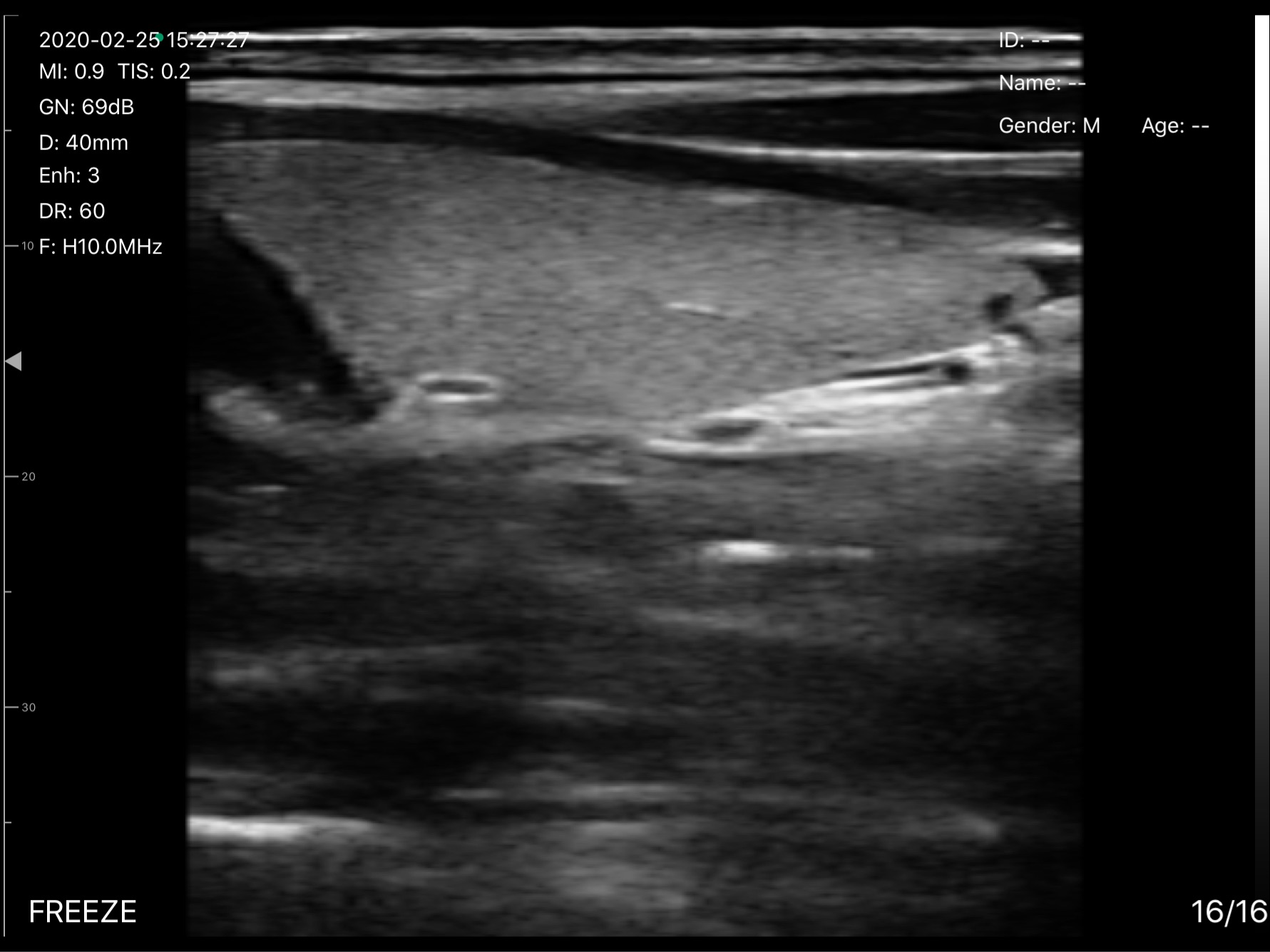 Thyroid lobe, longitudinal 2 · B-mode · D3Pro · 10 MHz scan preview