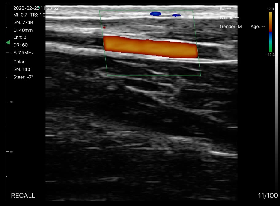 Wrist artery · Color Doppler · D3Pro · 7.5 MHz scan preview