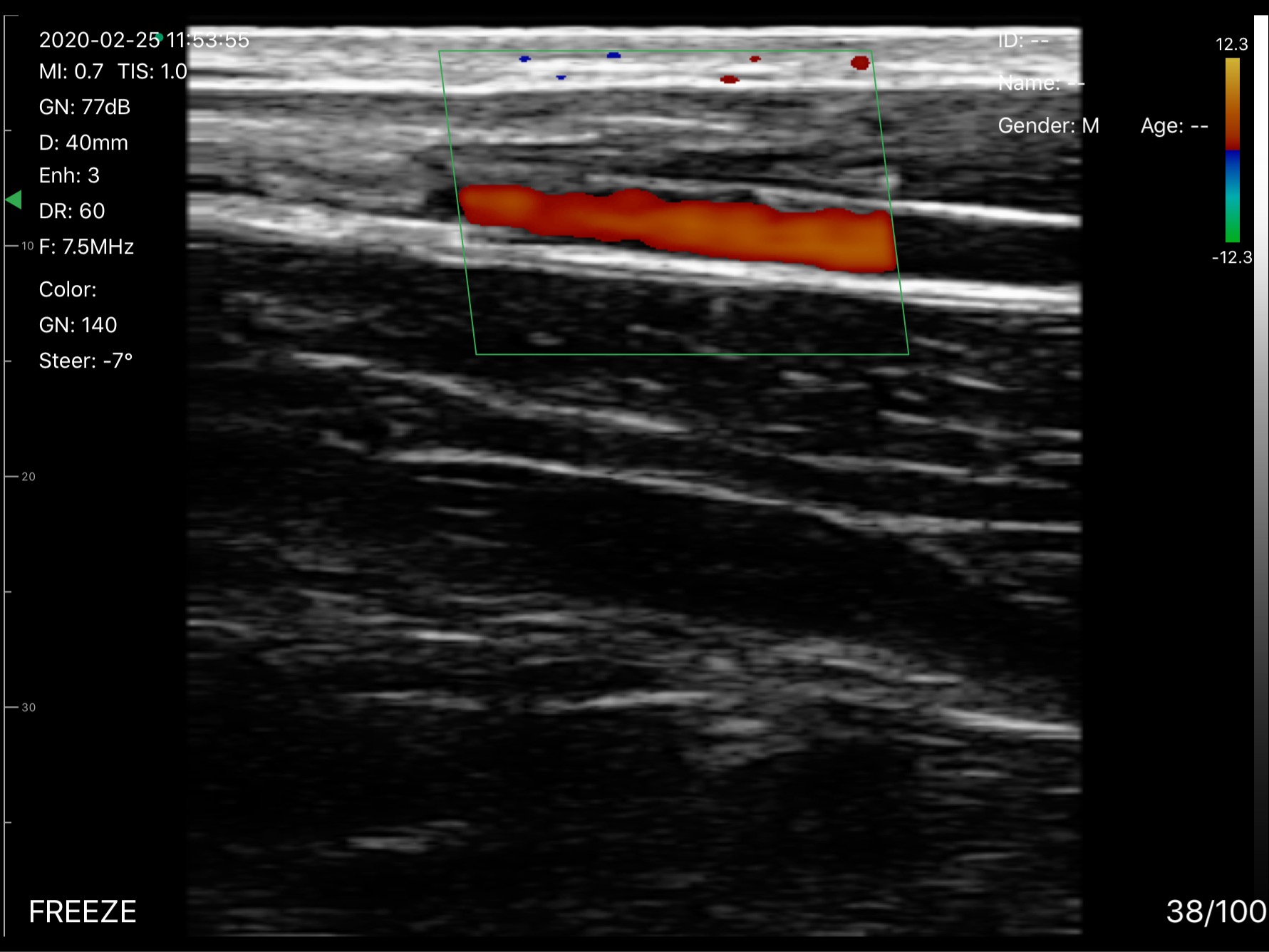 Wrist artery 2 · Color Doppler · D3Pro · 7.5 MHz scan preview