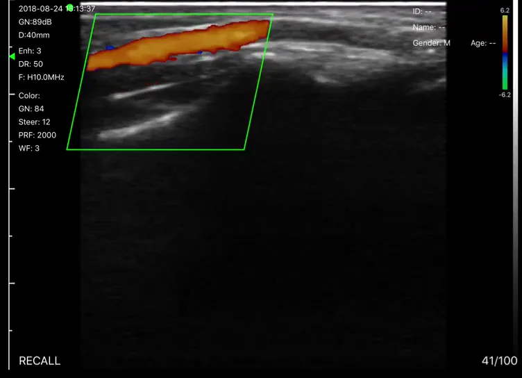 Oppervlakkig vat · Kleurendoppler · 10 MHz scanvoorbeeld