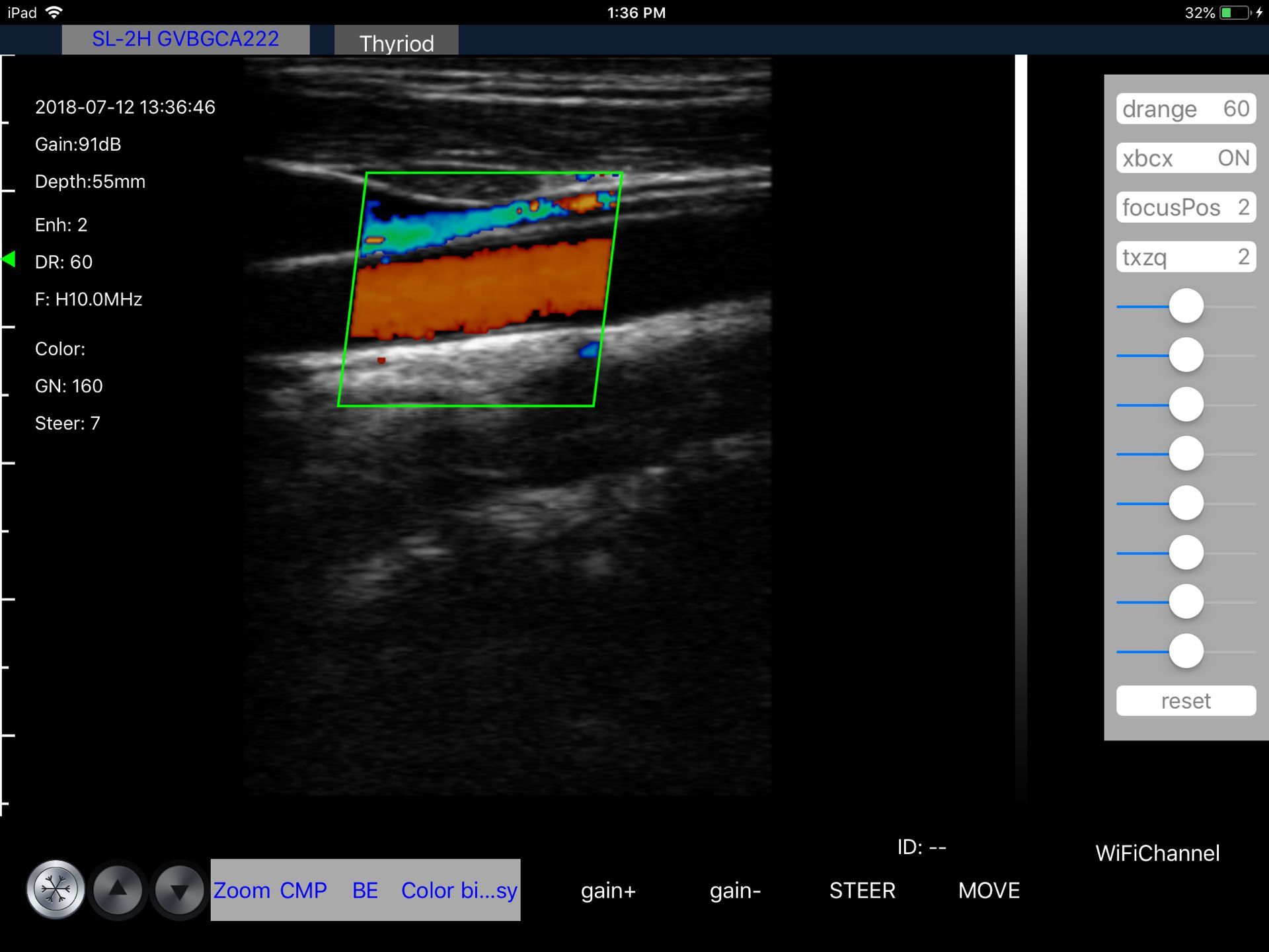 Carotid artery · Color Doppler · L10 · 10 MHz scan preview