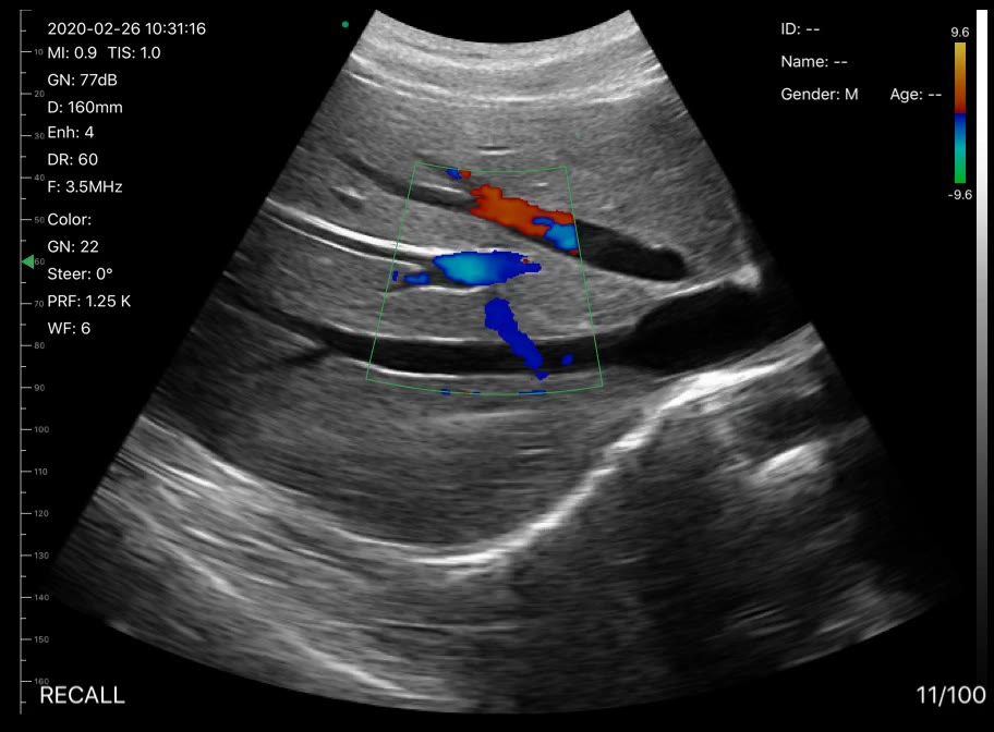 Liver vessels · Color Doppler · D3Pro · 3.5 MHz scan preview