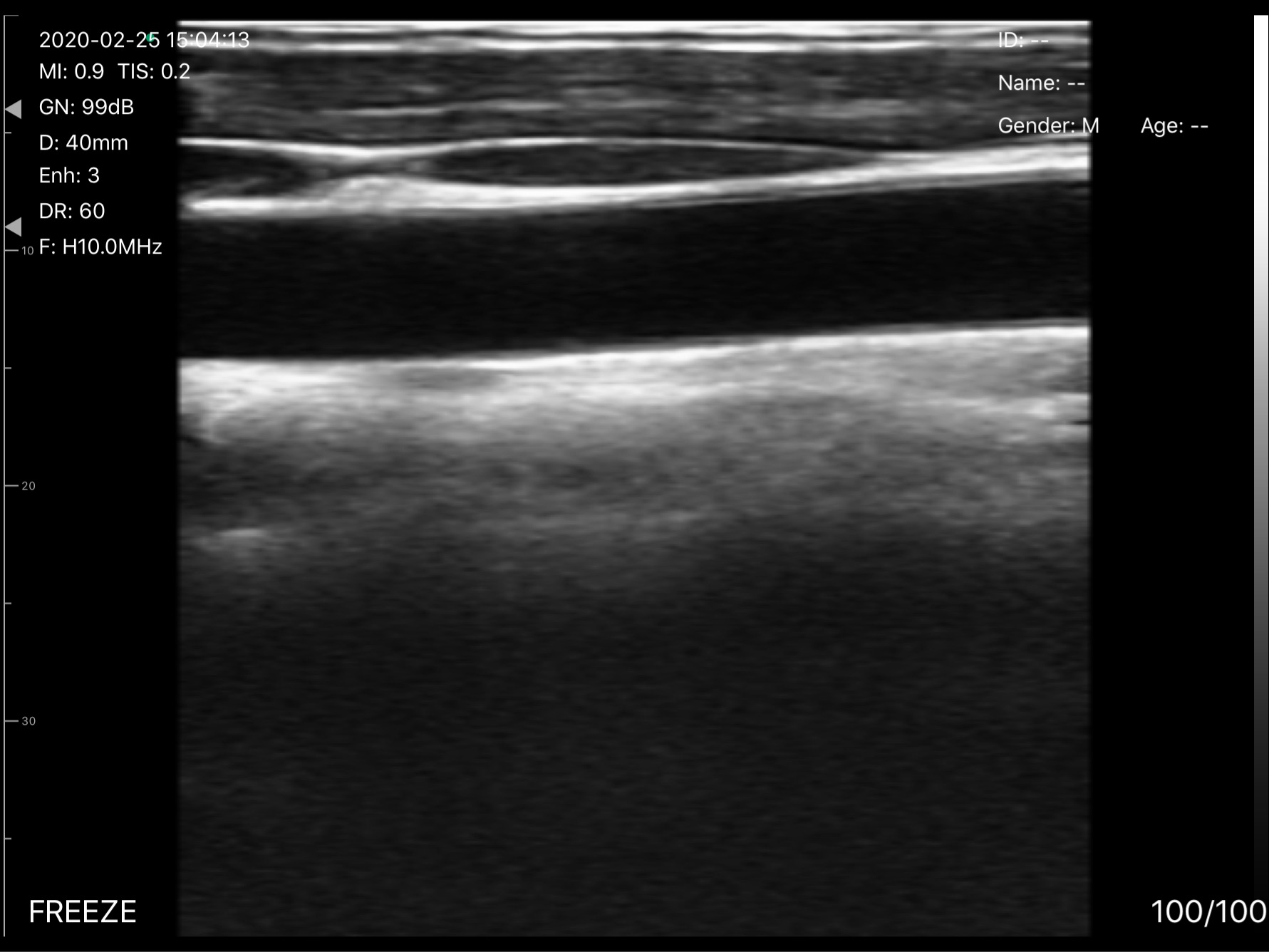 Carotid artery 2 · Color Doppler · D3 · Linear probe scan preview