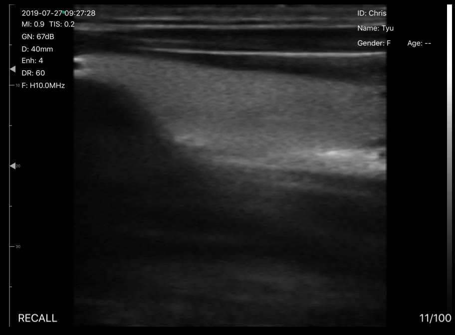 Carotid artery · Color Doppler · D3 · Linear probe scan preview