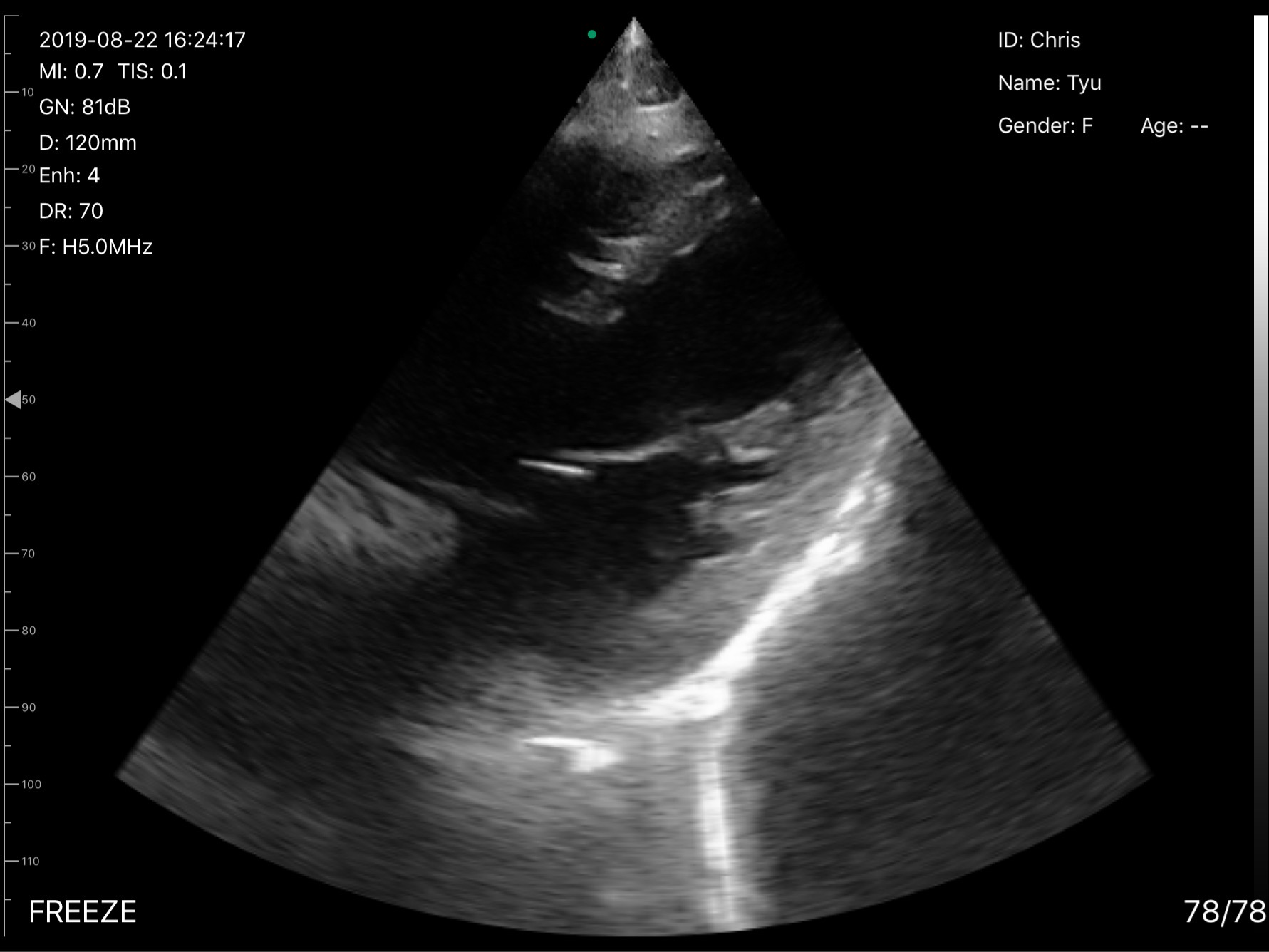 Cardiac view · B-mode · D3 · Phased array scan preview
