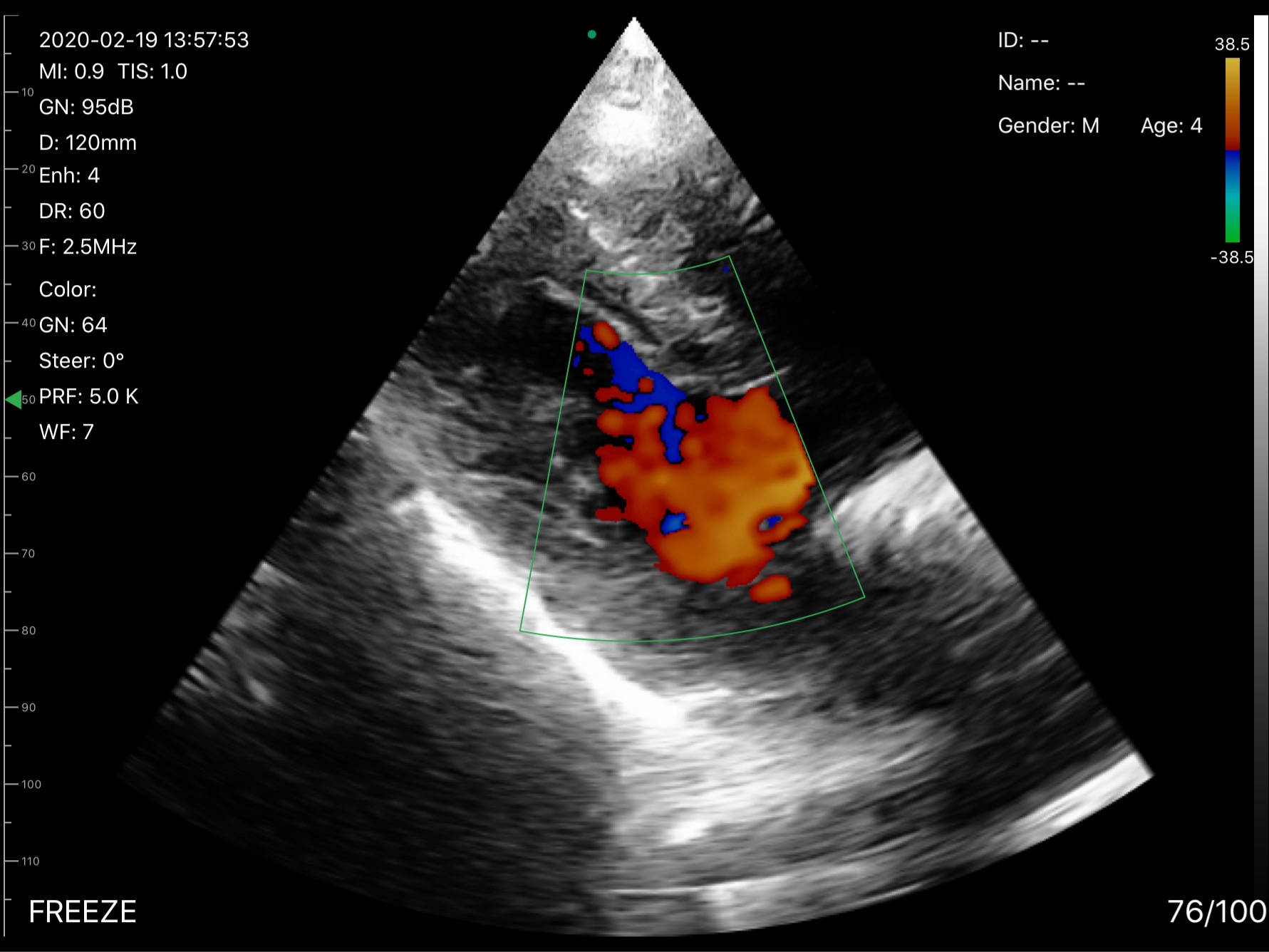 Cardiac flow · Color Doppler · D3 · Phased array scan preview
