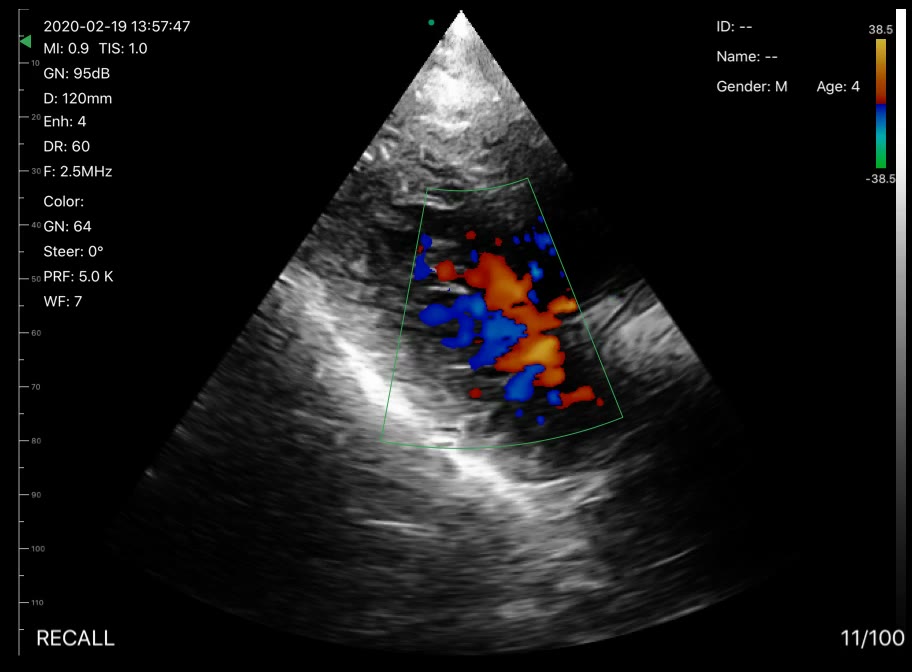 Cardiac view · Color Doppler · D3 · Phased array scan preview