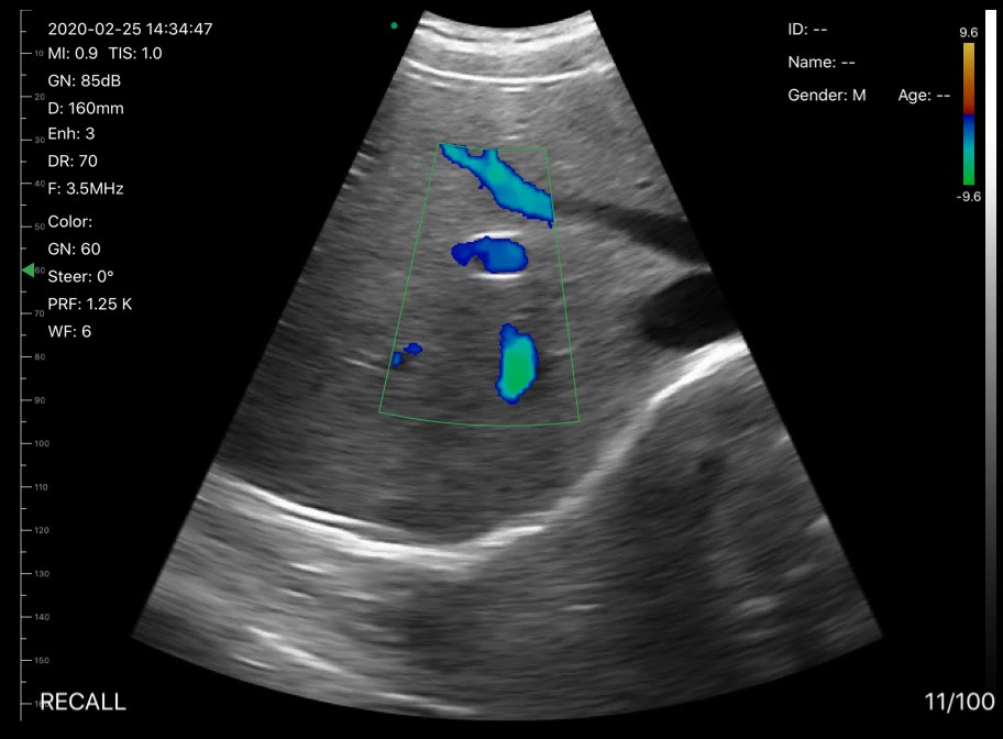 Liver vessels · Color Doppler · D3 · 3.5 MHz scan preview