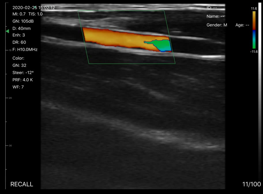 Wrist vessels 2 · Color Doppler · D3 · Linear probe scan preview