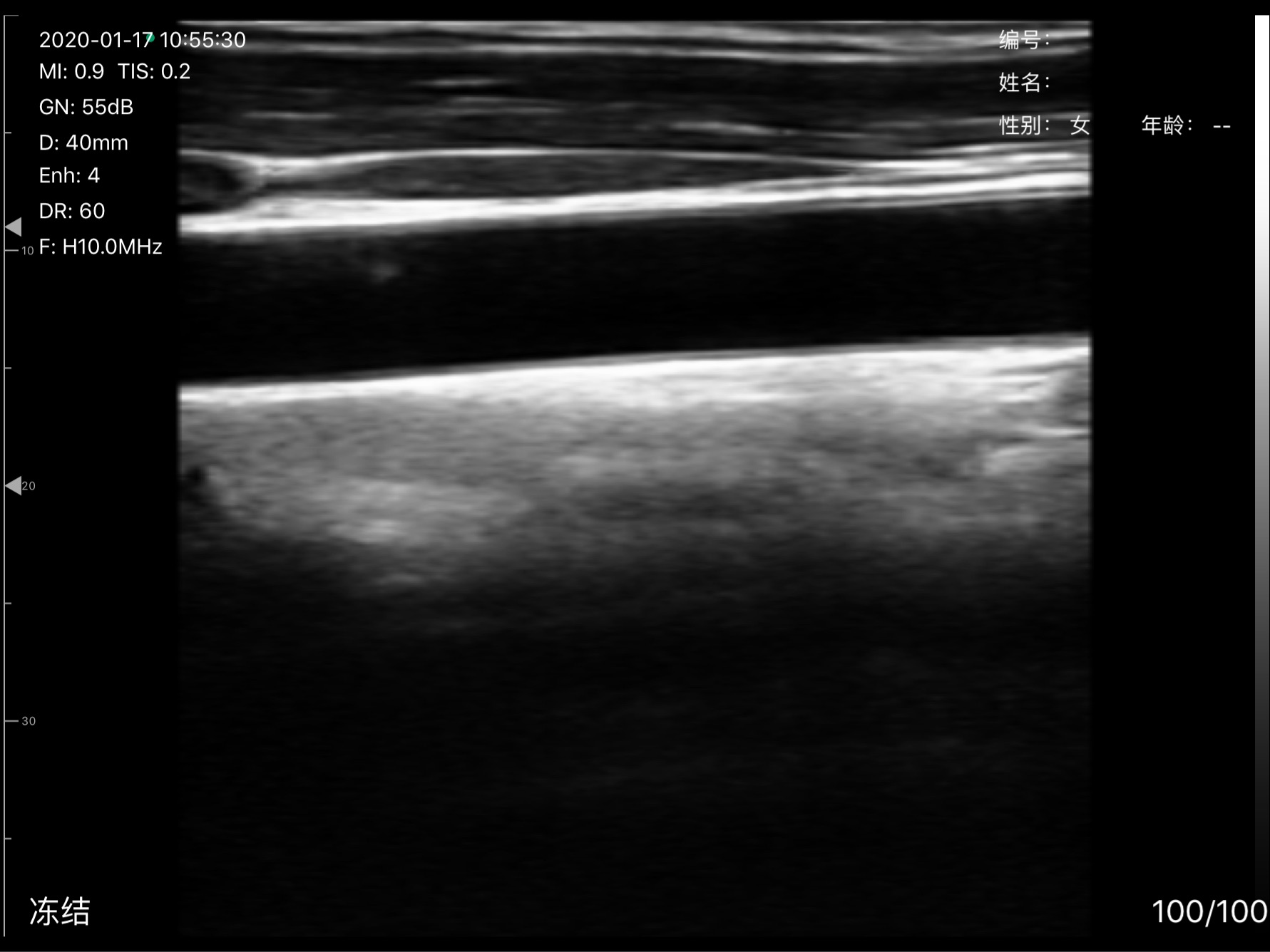 Carotid artery · Color Doppler · D3Pro · Linear probe scan preview