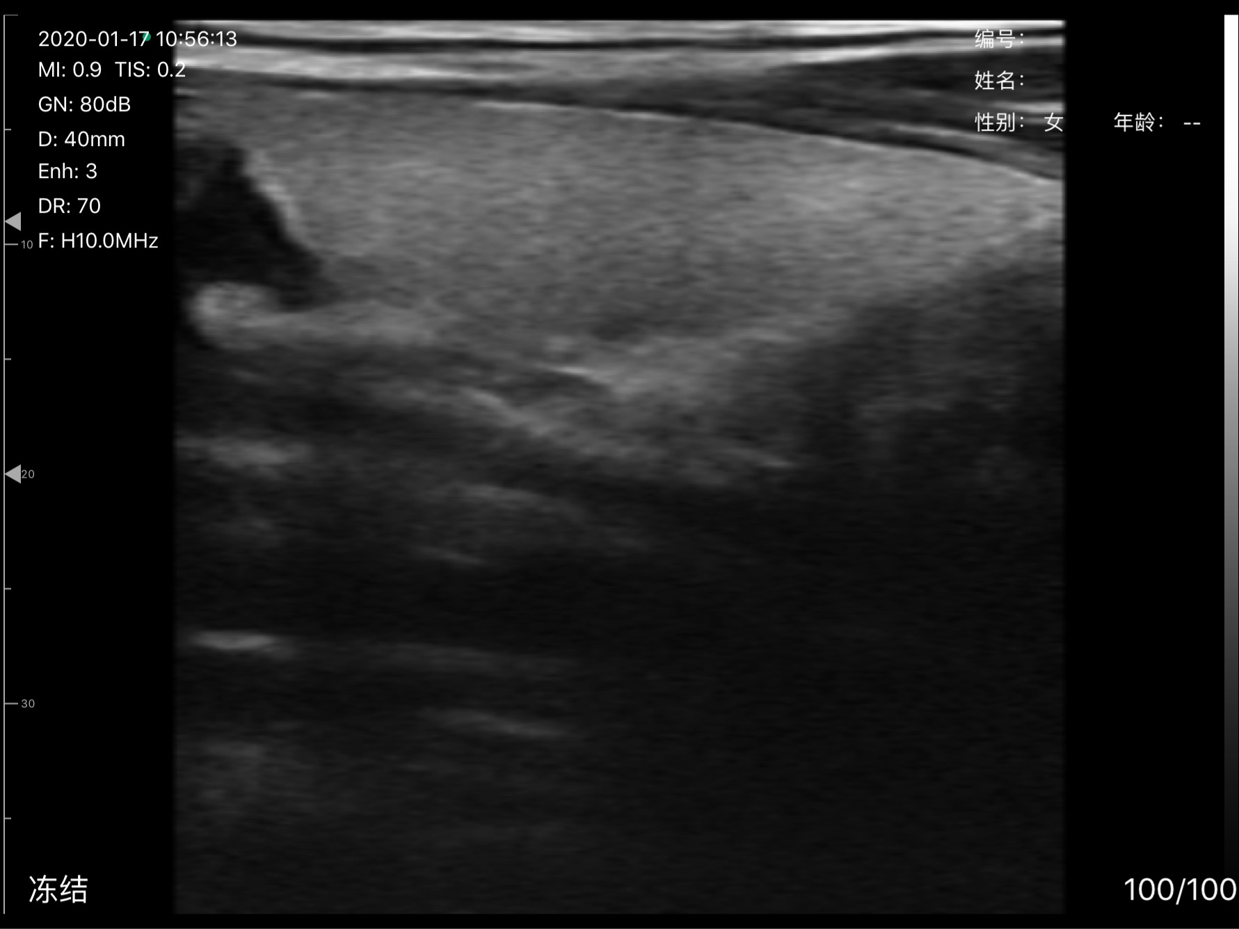 Thyroid lobe · B-mode · D3Pro · 10 MHz scan preview