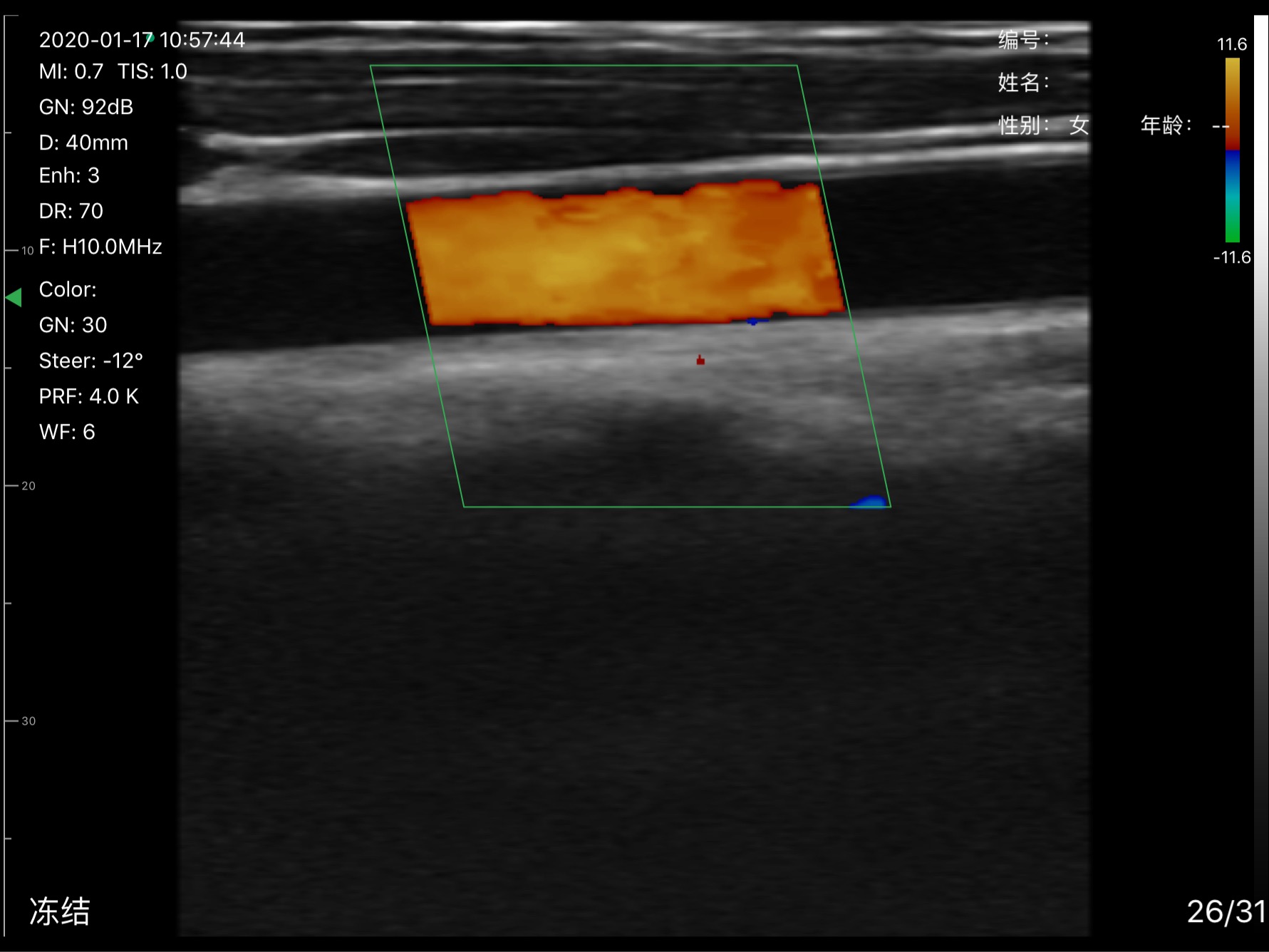 Carotid artery · Color Doppler · D3Pro · 10 MHz scan preview