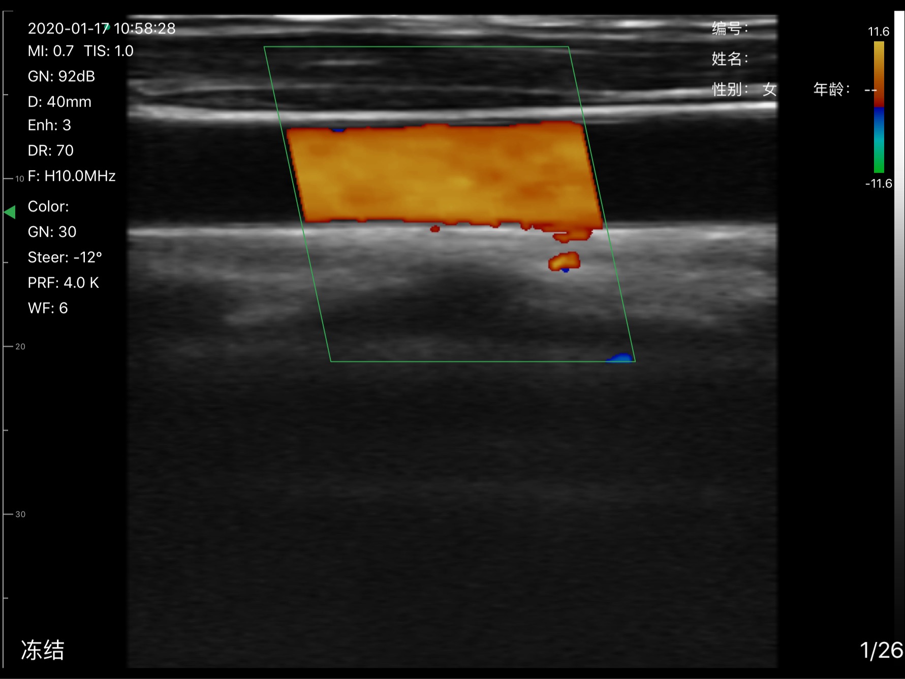 Carotid artery 3 · Color Doppler · D3Pro · 10 MHz scan preview