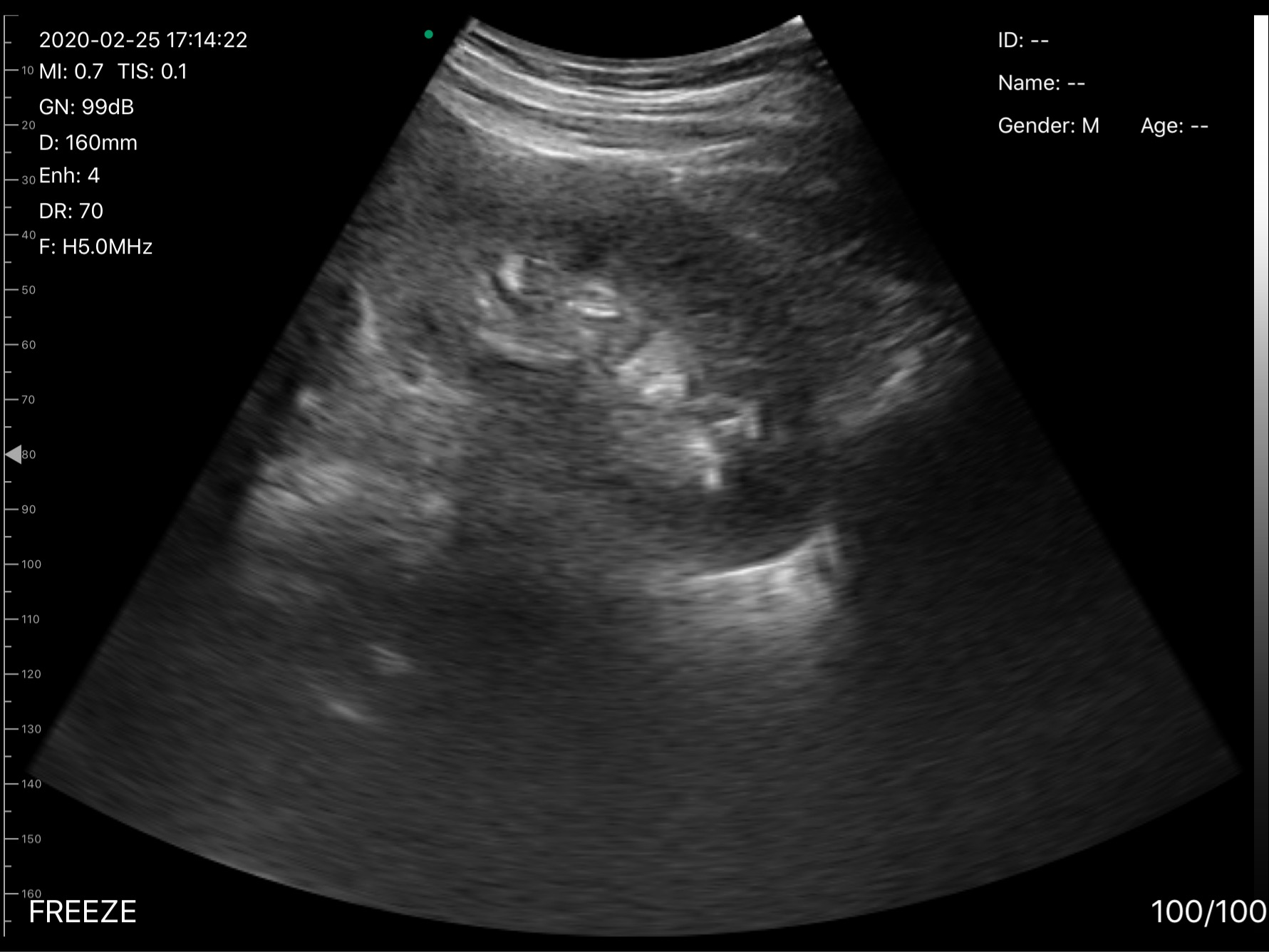 D3Pro Kidney Long View B-mode Ultrasound at 5 MHz Harmonic scan preview