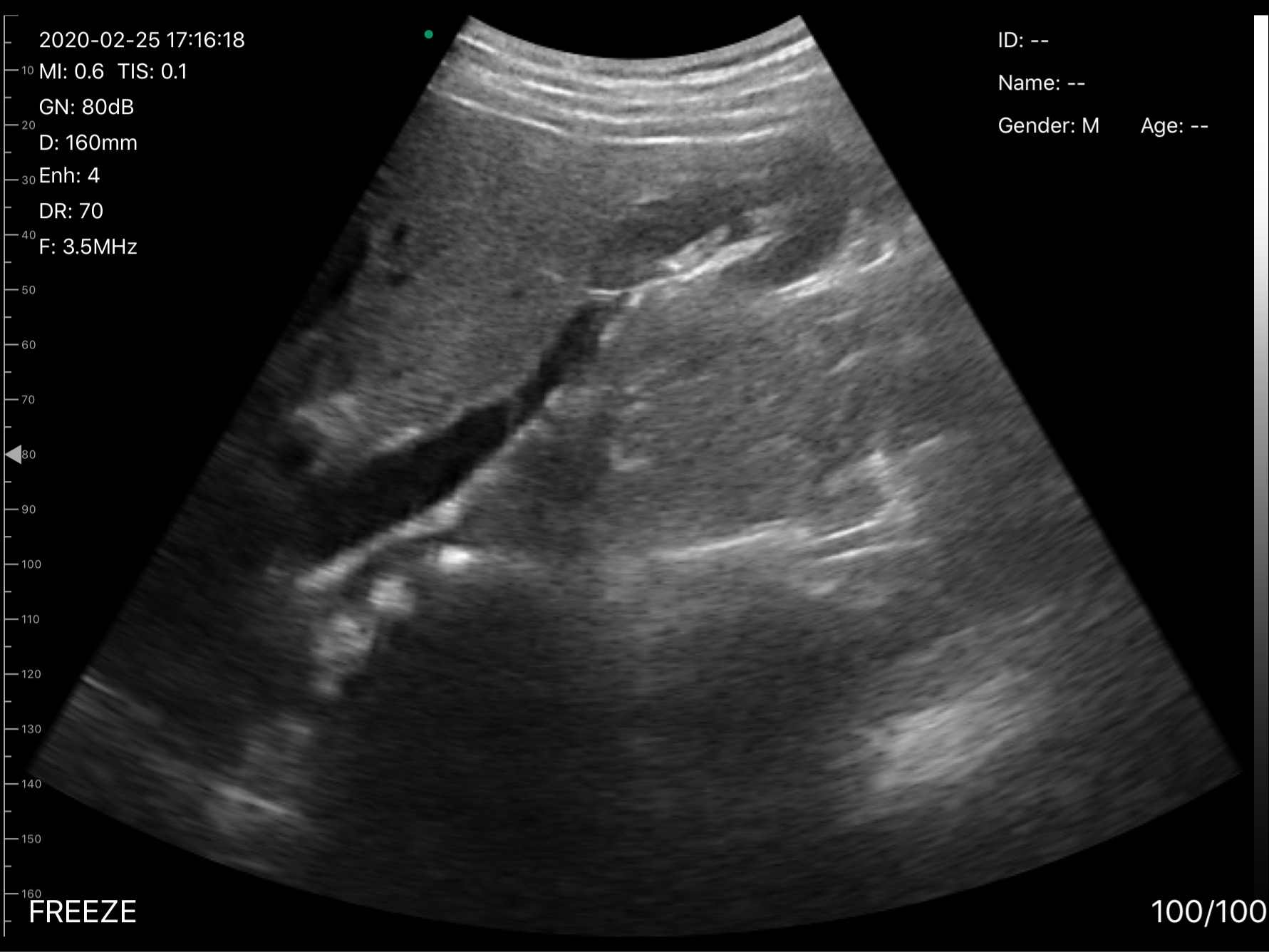D3Pro Kidney Region Penetration B-mode Scan at 3.5 MHz scan preview
