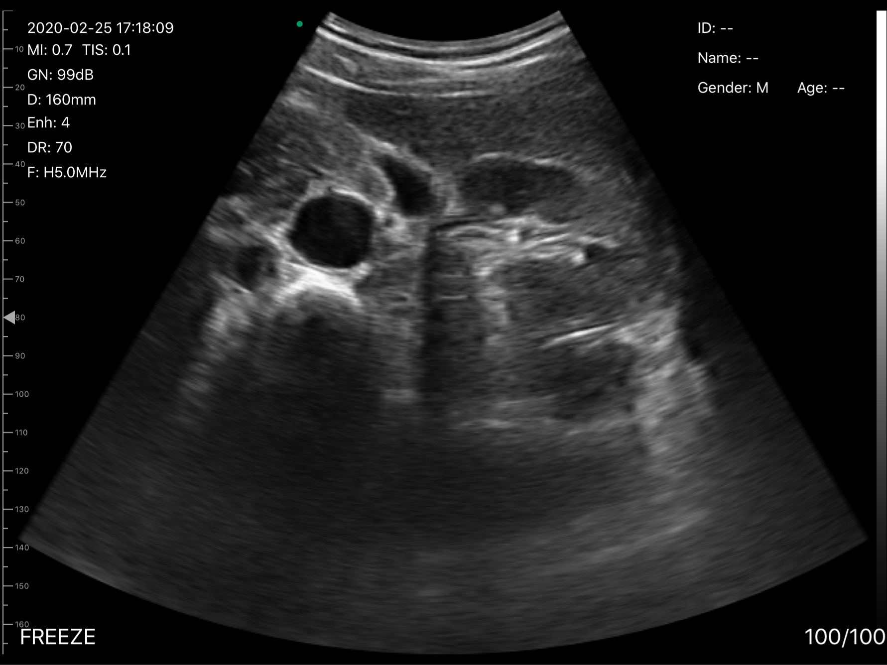D3Pro Kidney Transverse View with Hilar Vessels B-mode scan preview