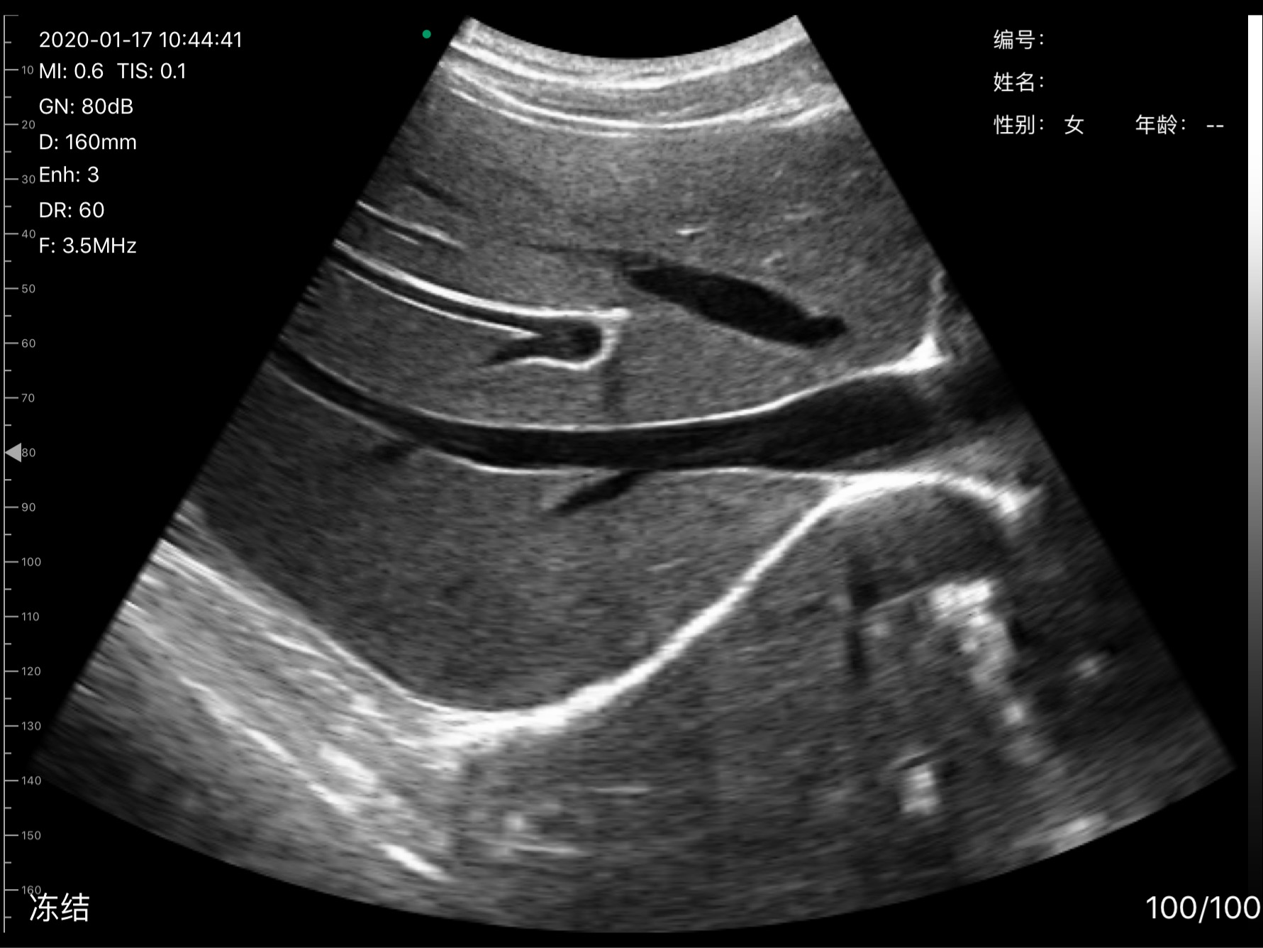 D3Pro Liver Portal Vein Branches B-mode Scan at 3.5 MHz scan preview