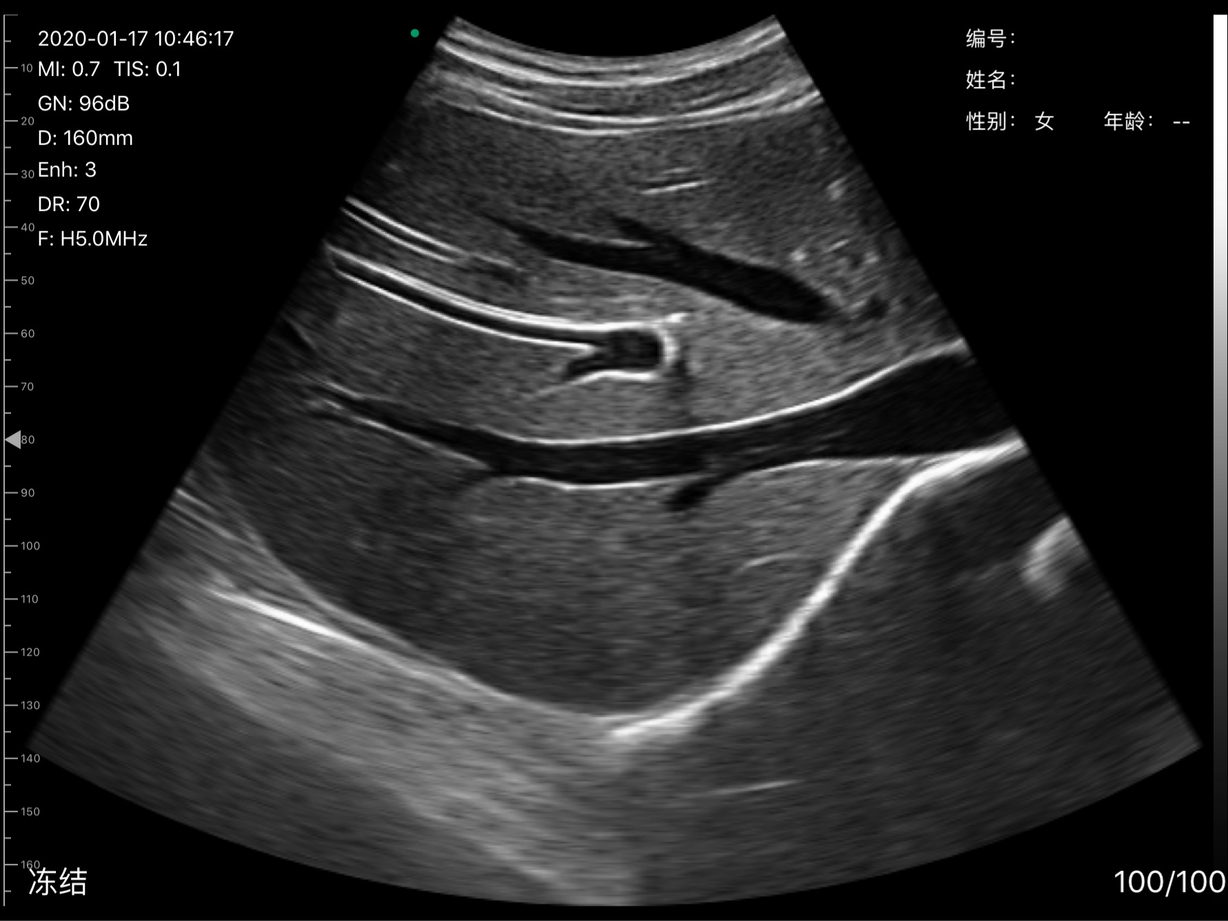 D3Pro Liver Hepatic Veins B-mode Scan at 5 MHz Harmonic scan preview