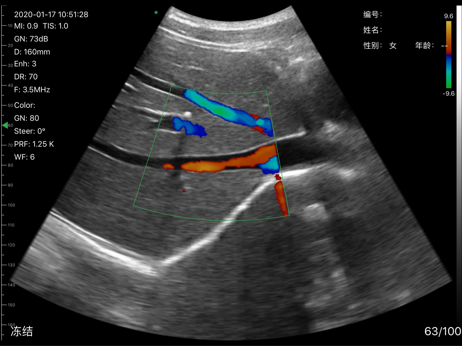 D3Pro Liver Color Doppler Vessel Flow at 3.5 MHz scan preview