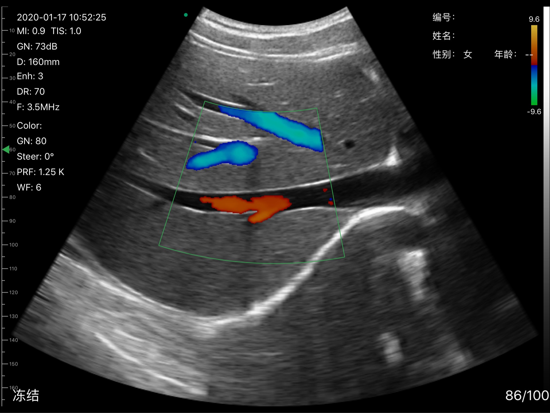Liver vessels · Color Doppler · D3Pro · Convex probe scan preview
