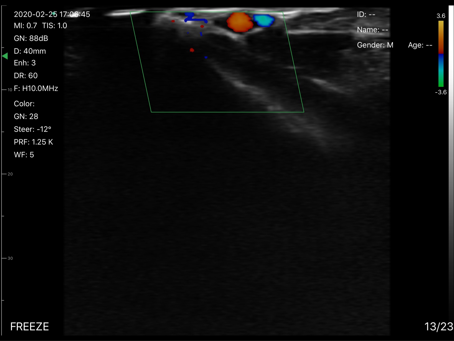 Radial artery and vein, transverse · Color Doppler · D3Pro · 10 MHz scan preview