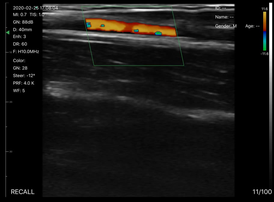 Wrist vessel · Color Doppler · D3Pro · Linear probe scan preview