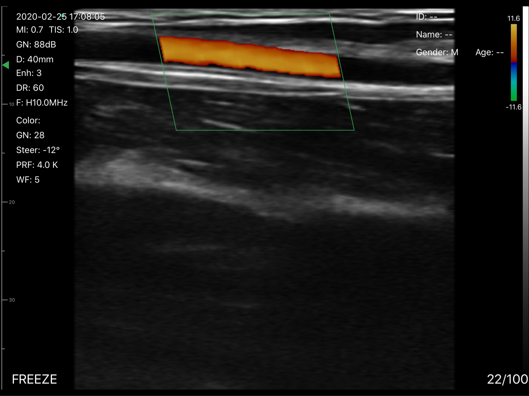 Wrist artery, longitudinal · Color Doppler · D3Pro · 10 MHz scan preview