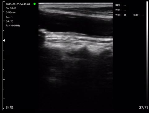 Carotid artery · B-mode · L10 · 10 MHz scan preview