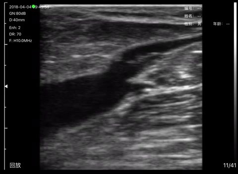 Saphenofemoral junction · B-mode · L10 · 10 MHz scan preview