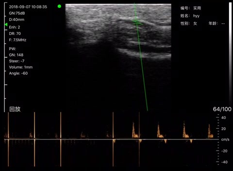 Forearm artery · PW Doppler · L10 · 7.5 MHz scan preview