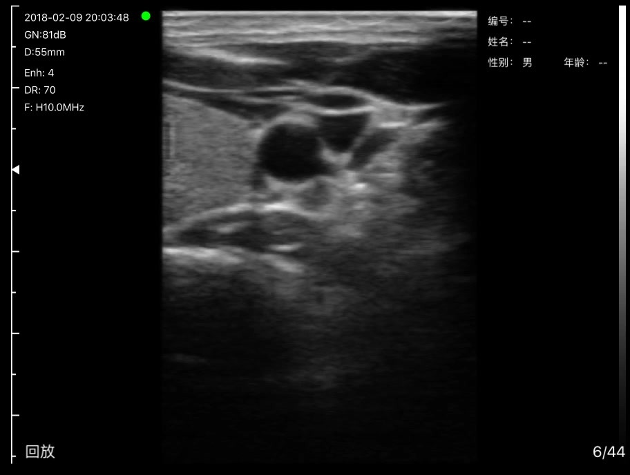 Neck vessels, transverse · B-mode · L10 · 10 MHz scan preview