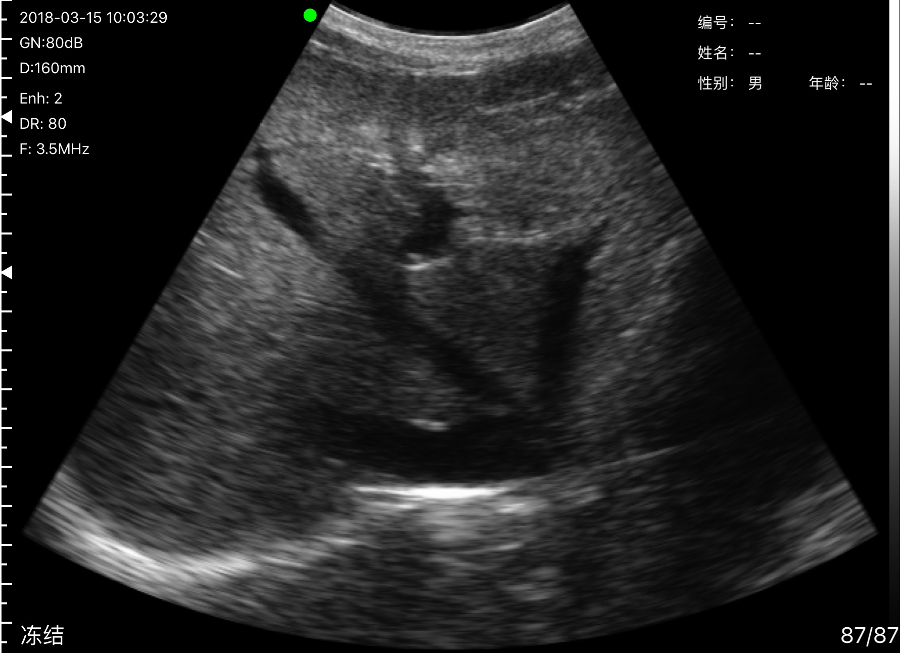 Hepatic veins draining into the IVC · B-mode · C5SH · 3.5 MHz scan preview