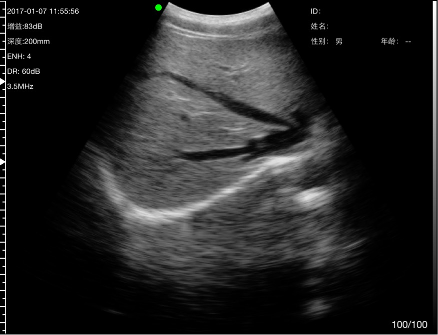 Hepatic veins 2 · B-mode · C5SH · 3.5 MHz scan preview