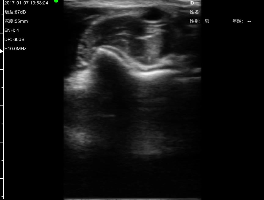 Ulnar artery · B-mode · L10 · Linear probe scan preview