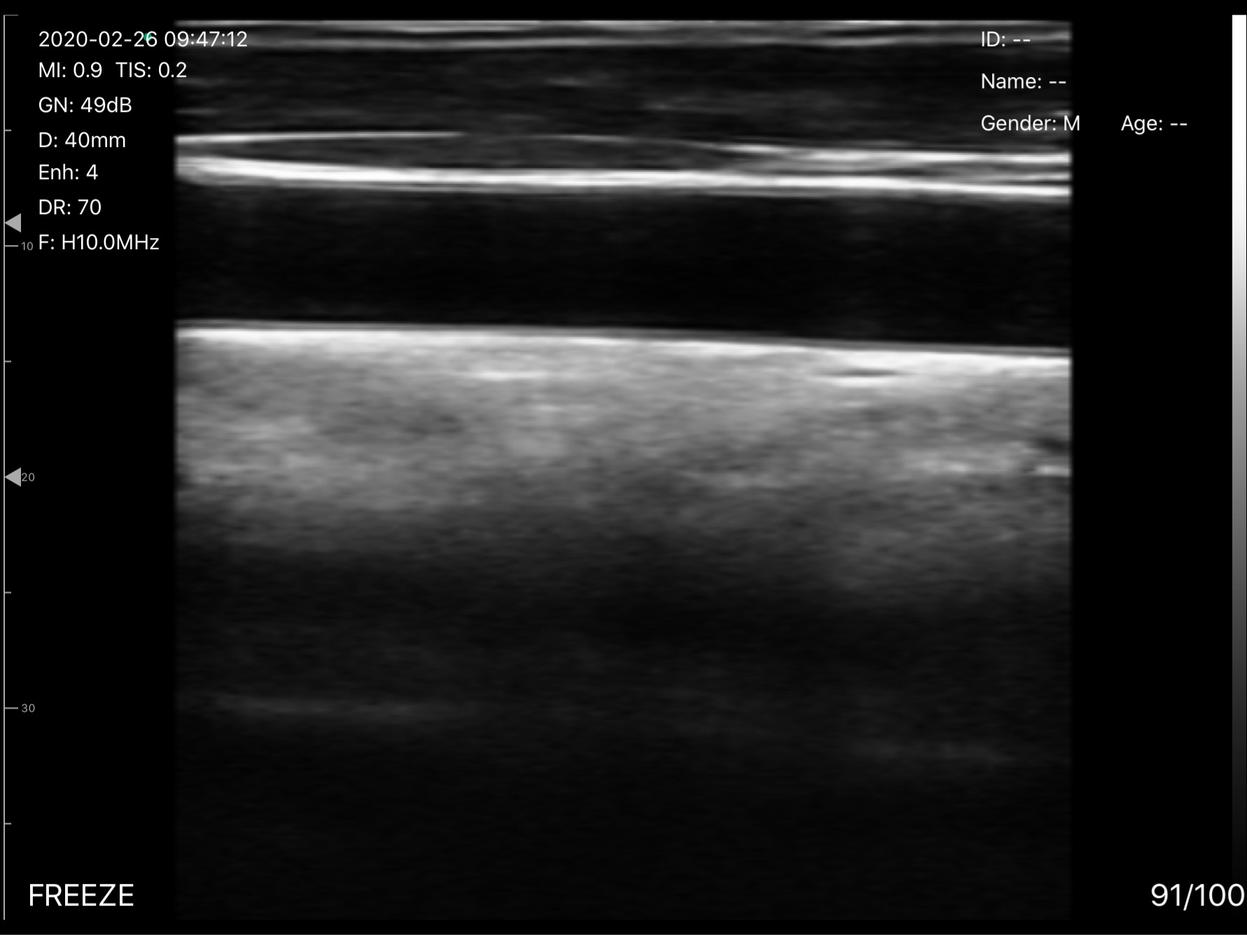 Carotid artery 2 · B-mode · D3Pro · 10 MHz scan preview