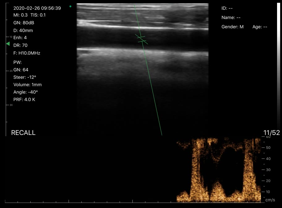 Carotid artery · PW Doppler · D3Pro · 10 MHz scan preview