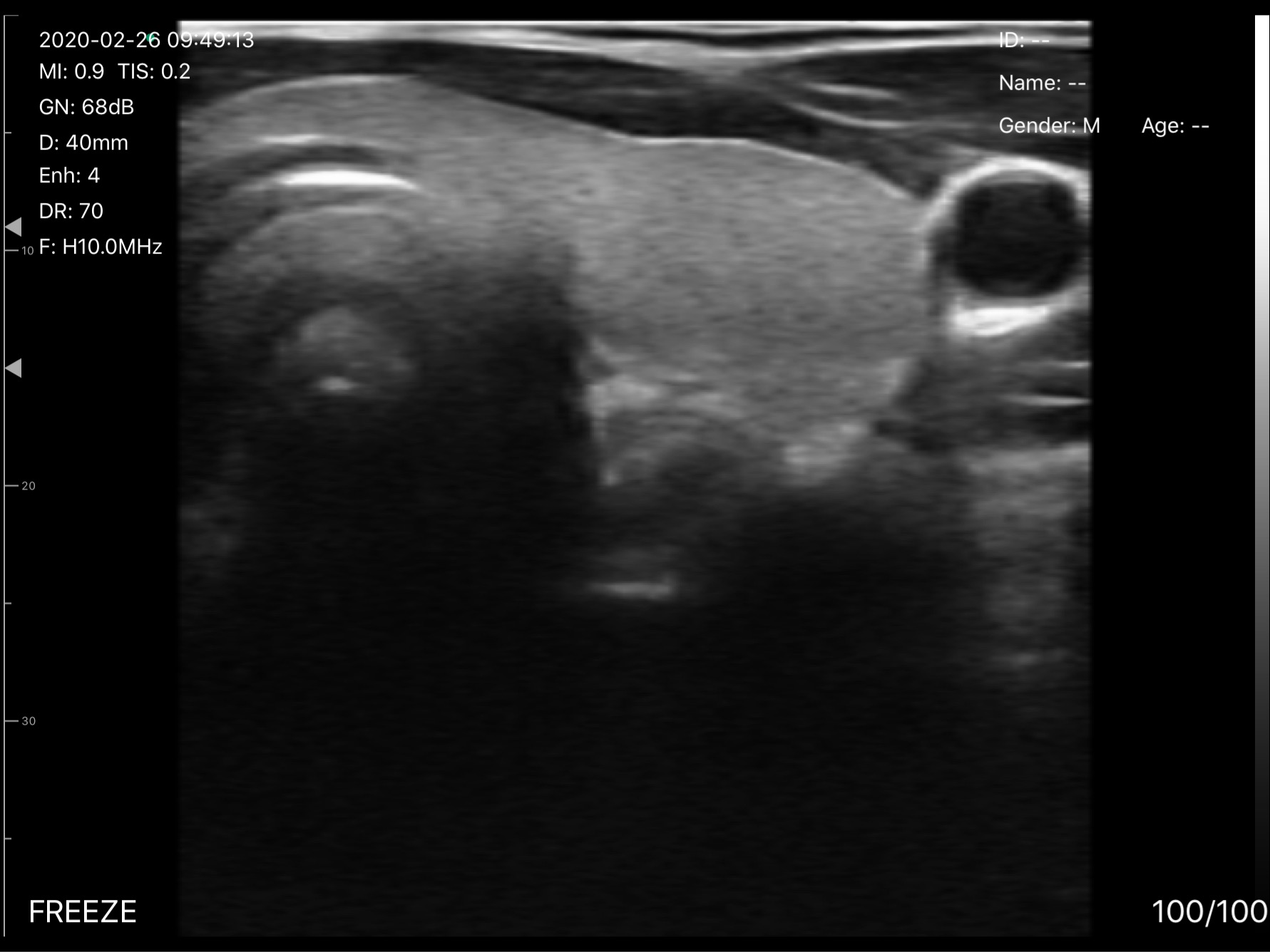 Thyroid lobe and common carotid artery 2 · B-mode · D3Pro · 10 MHz scan preview