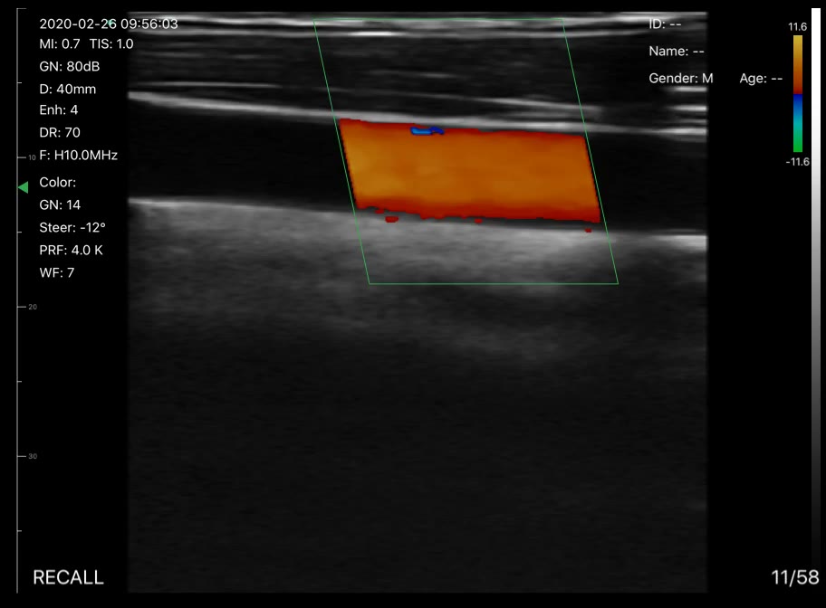 Carotid artery 4 · Color Doppler · D3Pro · 10 MHz scan preview