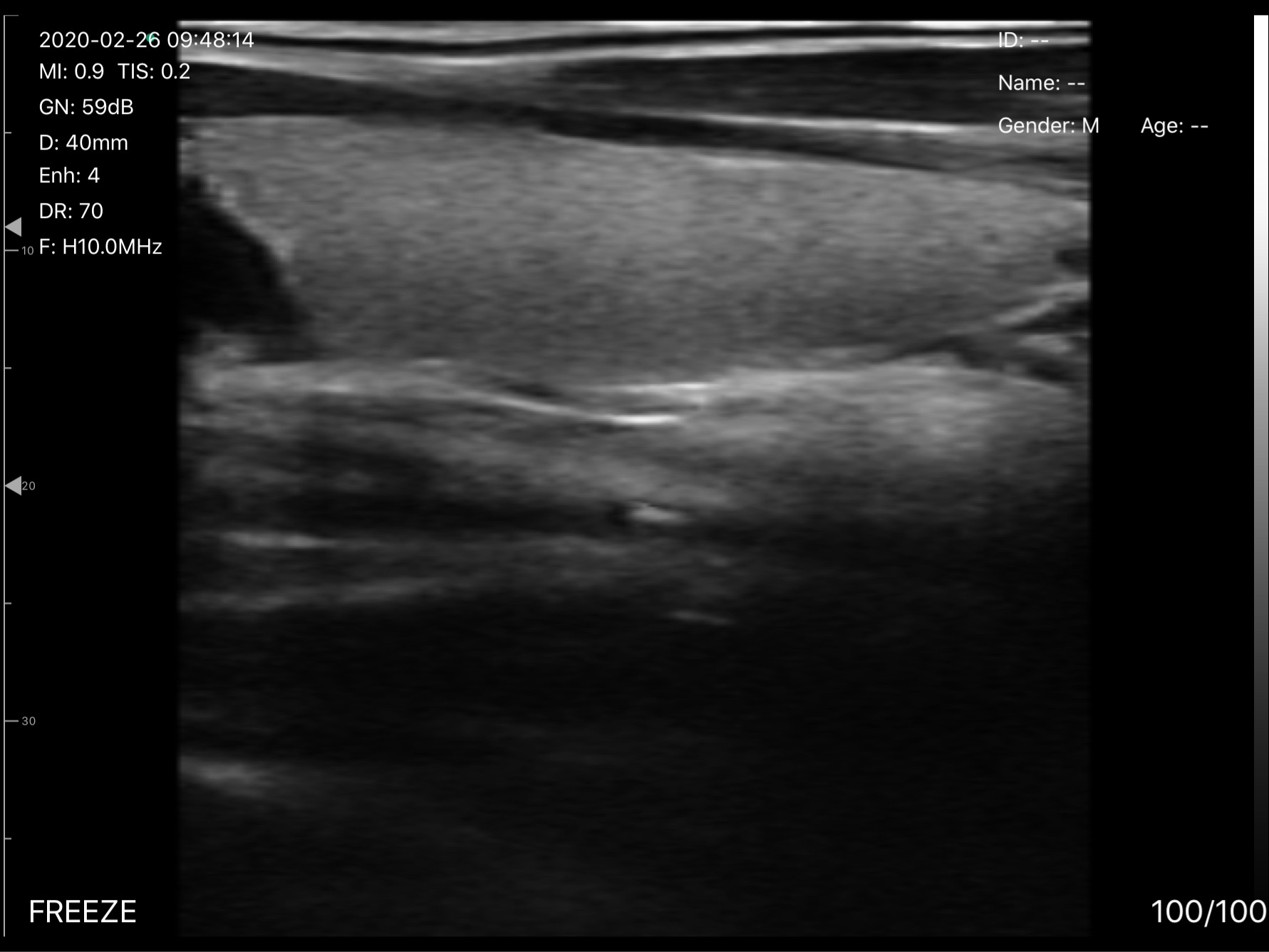Thyroid lobe, longitudinal · B-mode · D3Pro · 10 MHz scan preview