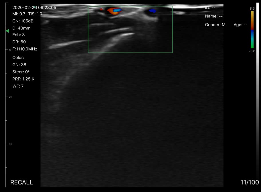 Wrist vessels, transverse · Color Doppler · D3Pro · 10 MHz scan preview