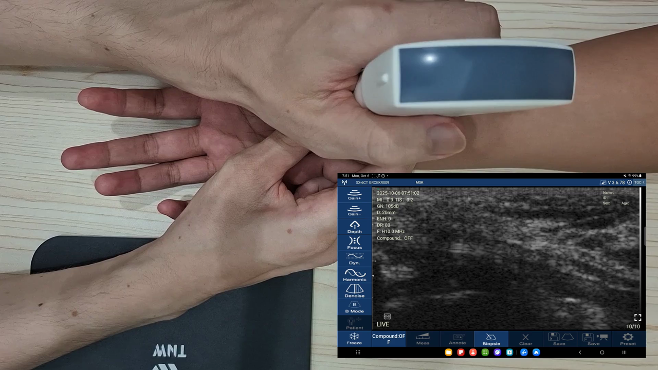 Scaphoid · B-mode · D3Ultra · 10 MHz scan preview