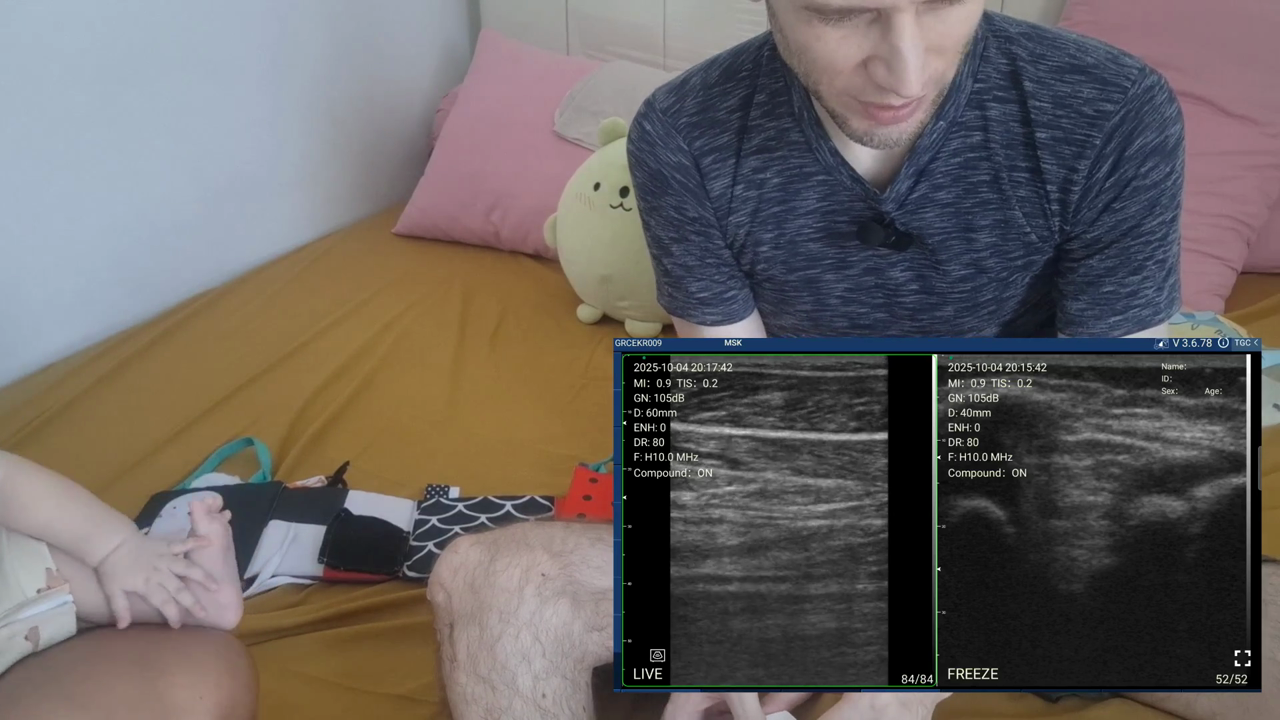 Calf and Achilles tendon, infant and adult · B-mode · D3Ultra · 10 MHz scan preview