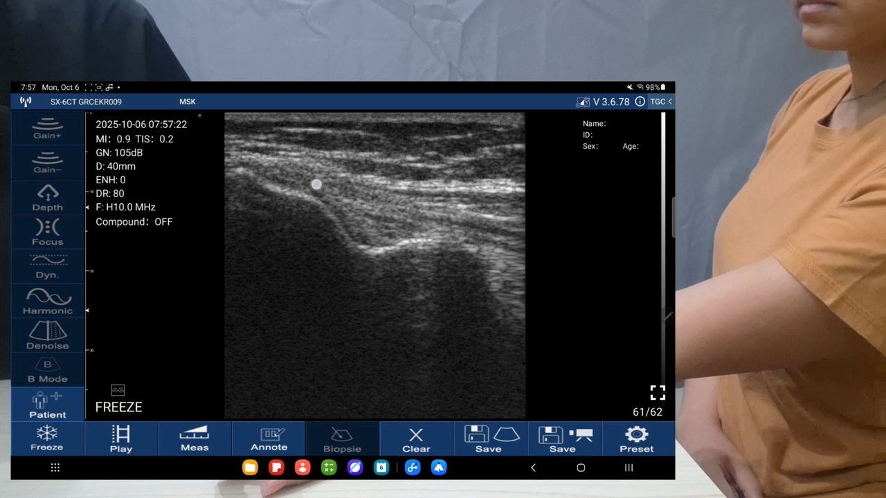 Common flexor tendon, medial elbow · B-mode · D3Ultra · 10 MHz scan preview