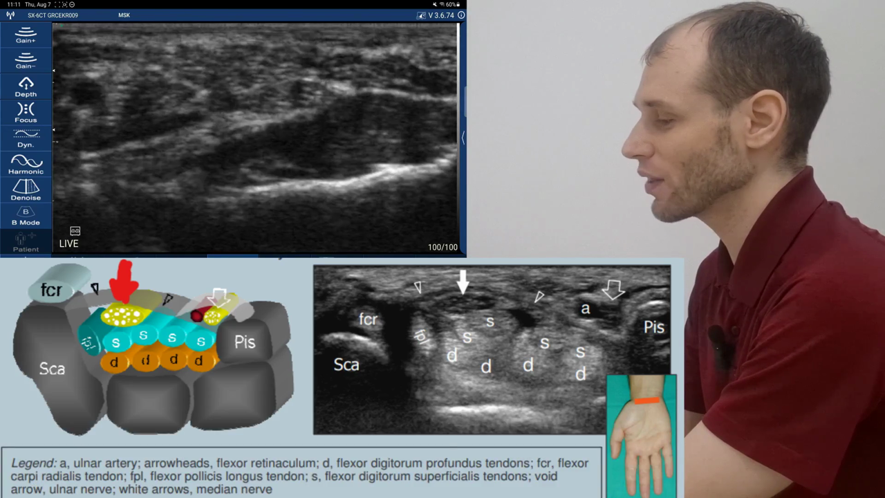 Median nerve at the carpal tunnel · B-mode · D3Ultra · 10 MHz scan preview