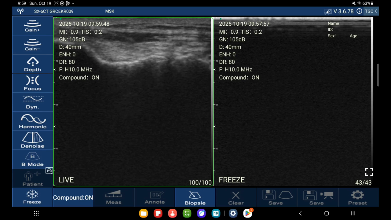 Ulnar collateral ligament, elbow · B-mode · D3Ultra · 10 MHz scan preview