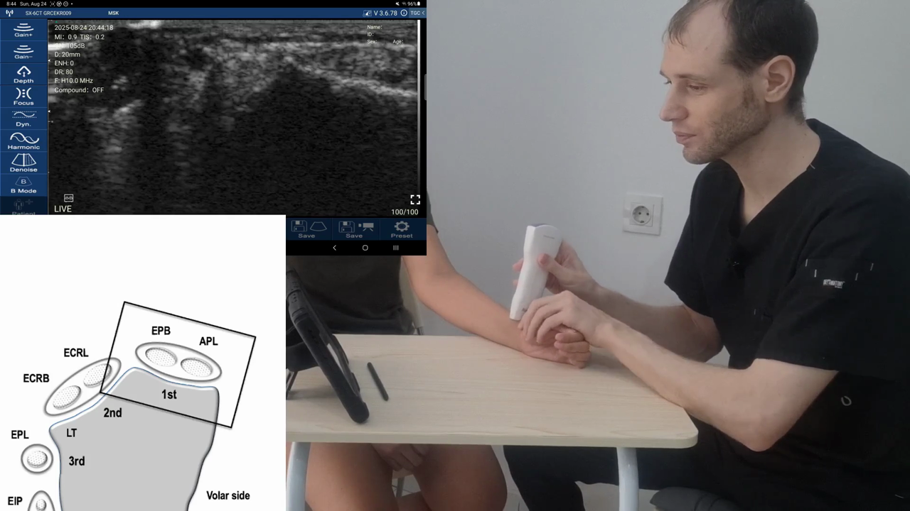 First extensor compartment (De Quervain's) · B-mode · D3Ultra · 10 MHz scan preview