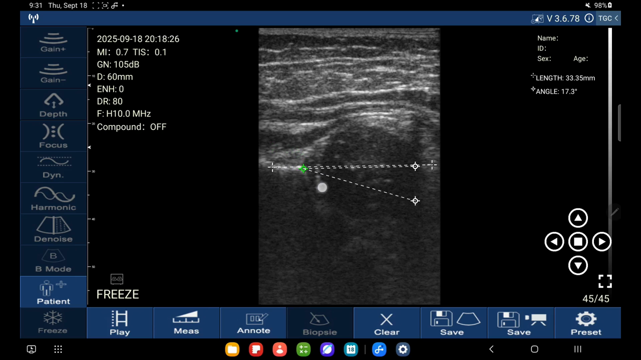 Infant hip, Graf method · B-mode · D3Ultra · Linear probe scan preview